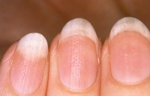Синдром наперстка на ногтях лечение thumbnail