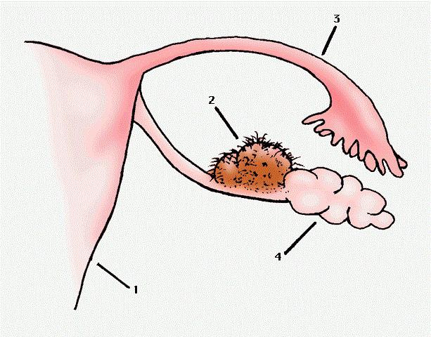 Операция при дермоидной кисте яичника thumbnail