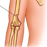 Виды переломов признаки переломов костей thumbnail