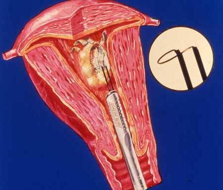 Гиперплазия эндометрия в менопаузе выскабливание отзывы thumbnail