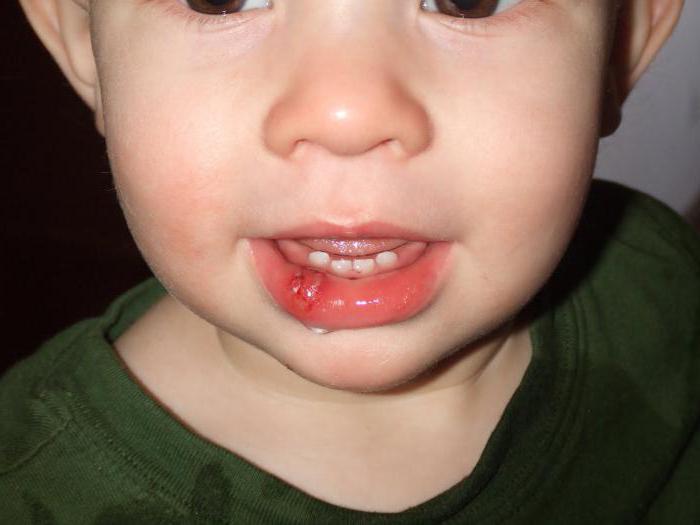 Как оказать первую помощь ребенку, который разбил губу изнутри?