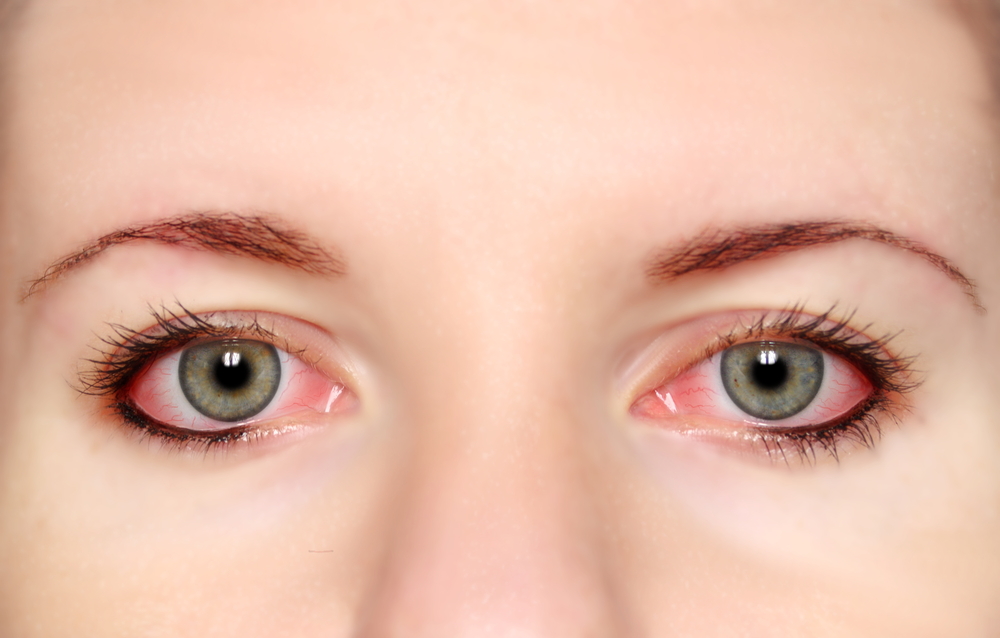 аллергия на глазах симптомы