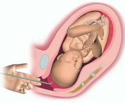 Искусственные роды: показания и последствия